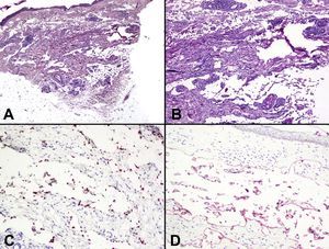A: Tumoración dérmica mal delimitada constituida por amplios espacios vasculares. (hematoxilina-eosina x10). B: Luces vasculares dilatadas dispuestas entre los haces de colágeno, revestidas por un endotelio plano de aspecto benigno, sin atipia nuclear, pleomorfismo celular ni mitosis. (hematoxilina-eosina x100). C: Los núcleos de las células endoteliales, que revestían las luces de las áreas a tipo linfangioma, se tiñeron con el marcador inmunohistoquímico para herpes virus tipo 8 (x200) D: Positividad para podoplanina en las células endoteliales (x200).