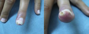 Lesión nodular en la región subungueal distal del cuarto dedo de la mano izquierda.