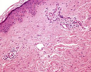 Urticaria convencional: epidermis normal. Dermis con edema. Infiltrados linfocíticos perivasculares leve-moderados. Vasodilatación (H-E ×10).