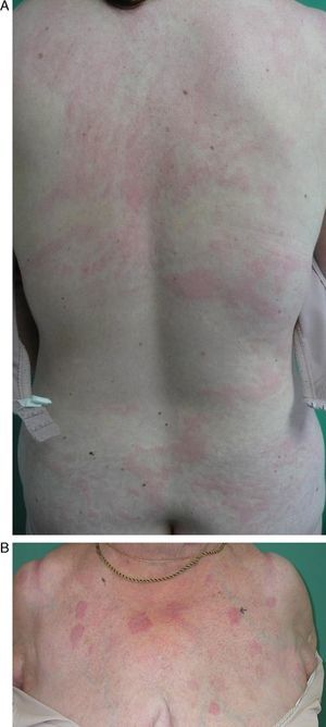 A. Múltiples lesiones habonosas parcialmente confluyentes con morfología circinada afectando la espalda de una mujer con urticaria aguda. B. Placas eritemato-edematosas bien delimitadas, ovaladas, algo infiltradas sin componente epidérmico.