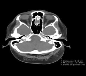 Tomografía computarizada que muestra el aumento del grosor del tejido celular subucutáneo del cuero cabelludo (3,12cm en el área occipital izquierda).