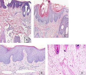 A.Biopsia del cuero cabelludo donde se observa un aumento del grosor del tejido celular subcutáneo con morfología normal de los folículos (HE x4). B. Epidermis hiperplásica con tapones de queratina en los infundíbulos foliculares (HE x20). C. Vasos sanguíneos dérmicos dilatados de aspecto telangiectásico (HE x10). D. No se observan depósitos anómalos ni paniculitis (HE x10).