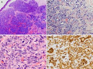 A. Proliferación celular que ocupa toda la dermis en la que se observa hemorragia intersticial y luces vasculares. B. Canales vasculares revestidos por células endoteliales con atipia, infiltrando entre los haces de colágeno. C. Células pleomórficas epitelioides, entre las que se observan varias mitosis atípicas. D. Tinción inmunohistoquímica con anticuerpo anti-CD31, positiva para las células proliferantes (hematoxilina-eosina. A x40, B x200, C x400; tinción inmunohistoquímica para CD31, D x200).