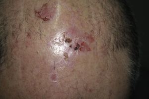 Lesiones ampollosas y erosivas en el cuero cabelludo.