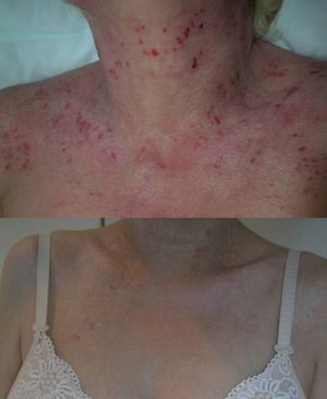 Imagen clínica de uno de nuestros casos antes y después del tratamiento con omalizumab en monoterapia (a los dos meses del inicio).