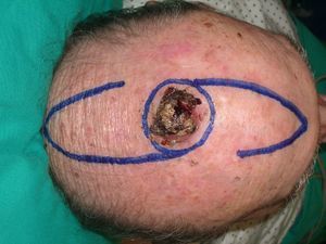 Carcinoma epidermoide en el cuero cabelludo de 3cm de diámetro con patrón de resección y colgajos en hacha.