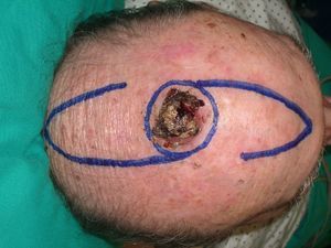 Carcinoma epidermoide en el cuero cabelludo de 3cm de diámetro con patrón de resección y colgajos en hacha.