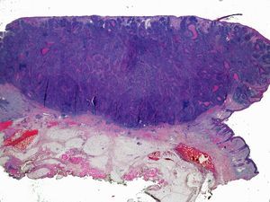Hematoxilina eosina 10×. Carcinoma epidermoide cutáneo pobremente diferenciado de morfología nodular.