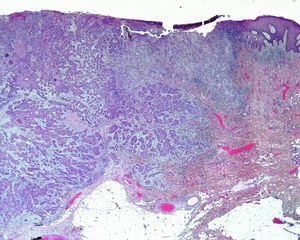 Hematoxilina eosina 10×. Carcinoma epidermoide cutáneo, que invade hasta dermis profunda e hipodermis, Clark IV.
