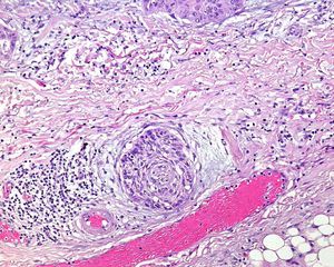 Hematoxilina eosina 100×. Carcinoma epidermoide cutáneo alrededor de una vaina nerviosa. En este tumor se aprecia claramente la invasión perineural.