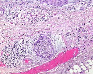 Hematoxilina eosina 100×. Carcinoma epidermoide cutáneo alrededor de una vaina nerviosa. En este tumor se aprecia claramente la invasión perineural.