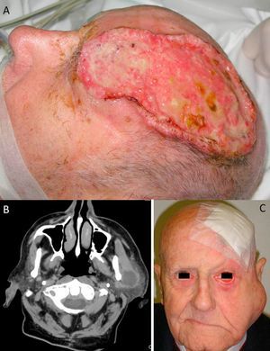A) Carcinoma epidermoide cutáneo (CEC) de gran diámetro en la zona frontoparietal izquierda de un paciente, este CEC tiene varios factores de alto riesgo como son el tamaño, la profundidad, un nivel Clark V (invade periostio) y pobre diferenciación. B) Imagen del mismo paciente con metástasis parotídeas de CEC visualizables en la tomografía axial computarizada. C) Imagen del mismo paciente intervenido del CEC, con metástasis parotídea ipsilateral y con parálisis facial asociada, debido a la invasión del VII par craneal por el CEC.