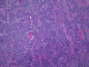 Hematoxilina eosina 40×. Carcinoma epidermoide cutáneo pobremente diferenciado. Se observan los nidos de células tumorales con necrosis central en algunas zonas.