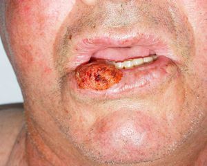Carcinoma epidermoide cutáneo en labio inferior. Esta zona se considera de alto riesgo y se ha incluido en la última clasificación de la AJCC.