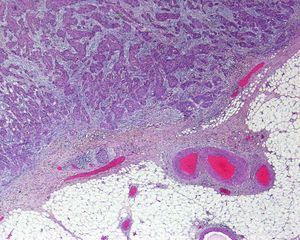 Hematoxilina eosina 20×. CEC en el que microscópicamente se aprecian varios factores de alto riesgo como son una moderada-pobre diferenciación histológica, una invasión en profundidad o Clark IV e invasión perineural de una vaina nerviosa por el CEC.