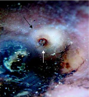 Con epiluminiscencia se observa un anillo de pigmentación marrón en torno a un poro central, rodeado de un halo blanquecino.