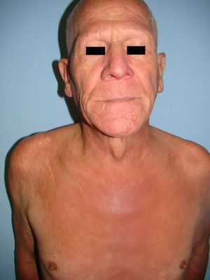 Alopecia universal y facies con piel infiltrada, sobre todo a nivel supraciliar, de aspecto «leonino».