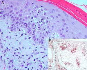 A. Presencia de un infiltrado inflamatorio en la dermis superficial constituido por linfocitos de núcleos irregulares aumentados de tamaño que infiltran la epidermis sobre focos de espongiosis leve (hematoxilina-eosina ×400). B. Técnica de inmunohistoquímica: positividad para anticuerpo anti CD8 (estreptavidina-biotina-diaminobencidina de novocastra ×100)