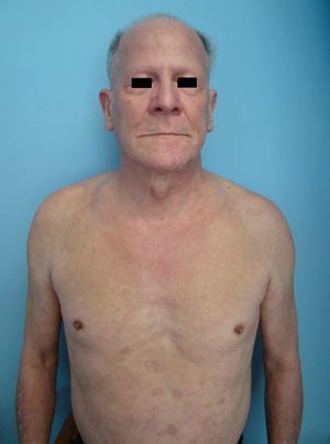 Evolución tras el tratamiento: descenso en el número de lesiones, ganancia de peso y recrecimiento del cabello en el cuero cabelludo y en las cejas.