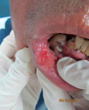 Clínica. Múltiples placas eritematosas, granujientas, de aspecto moriforme, en el labio inferior.