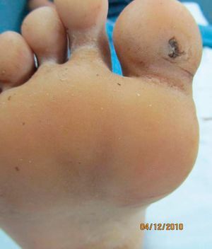 Clínica. Pequeña úlcera de bordes regulares y fondo limpio en la superficie plantar del primer dedo del pie derecho.