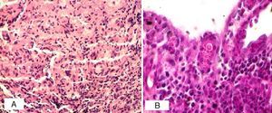 Histopatología. A) Corion con intensa reacción granulomatosa (H-E 10×). B) Célula gigante conteniendo esporos con gemación superficial (PAS 40×).