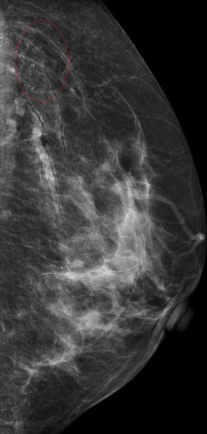 Mamografía de la mama izquierda.