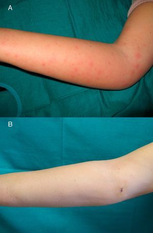 A) Linfedema y máculo-pápulas eritematosas en la cara interna de brazo y antebrazo derecho. B) Brazo derecho sin lesiones a la semana de iniciar el tratamiento.