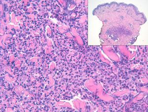 Infiltrado inflamatorio dérmico neutrofílico de predominio perivascular y también intersticial.