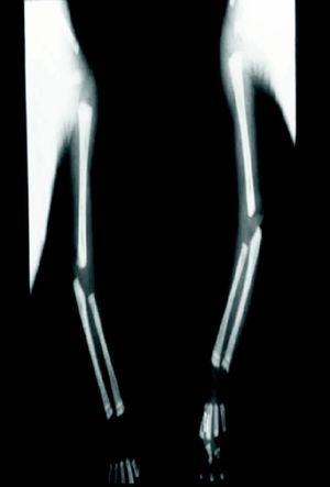 Radiografía de extremidades superiores con imágenes osteolíticas en metafisis proximal y distal de húmero, cúbito y radio bilateral.