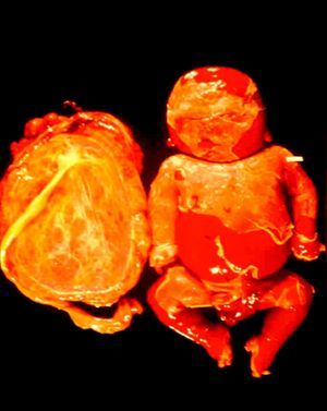 Feto macerado y placenta grande, gruesa y pálida, de hasta un tercio del peso del feto.