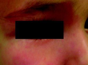 Lesión eritematosa en la cara de tonalidad rosada, un poco más pálida que las manchas en vino de Oporto, aunque en ocasiones el diagnóstico diferencial es imposible.