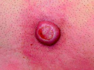 Nódulo eritematovioláceo con rodete eritematoso y ulceración central en el tórax.