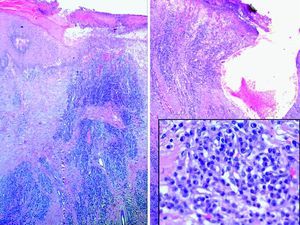 Lesión nodular con ulceración central cubierta de fibrina con un componente vascular importante e infiltrado inflamatorio basófilo de predominio perivascular. No se observa patrón arquitectural lobular. Detalle del infiltrado de células plasmáticas.
