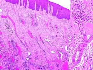 Capilares y vénulas dilatadas y focalmente (detalle inferior) prominencia y vacuolización endotelial. Cuerpos de Rusell en el infiltrado inflamatorio (detalle superior).