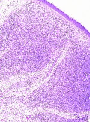 En la biopsia se observó una proliferación linfoide de disposición nodular distribuida por toda la dermis alcanzando la hipodermis, sin evidencia de epidermotropismo.