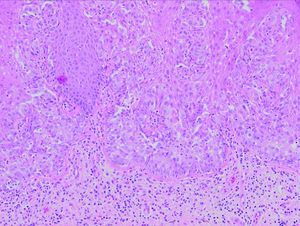 Células de citoplasma amplio y claro con núcleos pleomórficos (células de Paget), distribuidas por todo el espesor de la epidermis. El estudio inmunohistoquímico fue positivo para CEA, EMA y CK7.