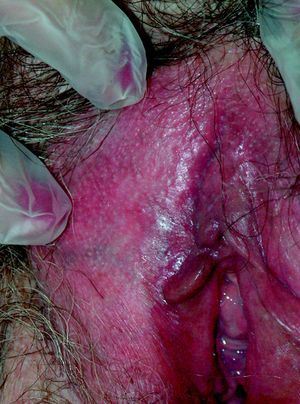 Resolución completa de las lesiones. Imagen tomada 3 meses después de finalizar el tratamiento.