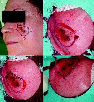 A-D) Extirpación de una franja de piel alrededor de la lesión, por sectores, y sutura.
