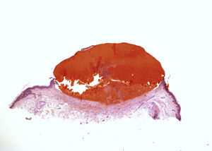 Ampolla intraepidérmica con sangre, fibrina y algunos neutrófilos en su interior. Sin signos de vasculitis (hematoxilina-esosina, x10).