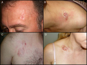 Imágenes clínicas de dermatofibrosarcoma. A. Dermatofibrosarcoma en zona frontal izquierda en forma de placa tumoral. B. Dermatofibrosarcoma en zona supraclavicular con nódulos en superficie. C. Dermatofibrosarcoma en el tórax con aspecto de placa cicatricial. D. Dermatofibrosarcoma en zona supraclavicular con nódulos en superficie.