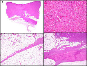 Imágenes histológicas de dermatofibrosarcoma. A. Imagen histológica de un dermatofibrosarcoma, visión panorámica (hematoxilina y eosina, 12,5x). B. Patrón estoriforme del dermatofibrosarcoma (hematoxilina y eosina, 100x). C. Infiltración del dermatofibrosarcoma en forma de prolongación digitiforme (hematoxilina y eosina, 40x). D. Infiltración muscular por dermatofibrosarcoma (hematoxilina y eosina, 40x).