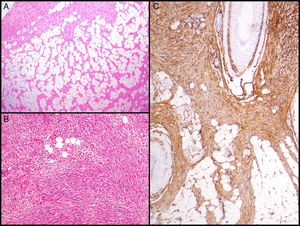 Imágenes histológicas de dermatofibrosarcoma. A. Infiltración del tejido celular subcutáneo en forma de panal de abeja (hematoxilina y eosina, 40x). B. Patrón fibrosarcomatoso de un dermatofibrosarcoma (hematoxilina y eosina, 100x). C. Tinción con CD 34 de un dermatofibrosarcoma (hematoxilina y eosina 100x).