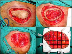 Cirugía de Mohs diferida en el dermatofibrosarcoma protuberans. A. Debulking o extirpación ajustada del tumor. B. Primer estadio de Mohs. Anillo cutáneo de piel clínicamente sana con referencia. C. Defecto tras el primer estadio. Exposición del plano muscular. D. División de la pieza por el patólogo.