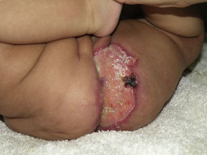 Úlcera de bordes eritematovioláceos y fondo brillante en región perianal izquierda.