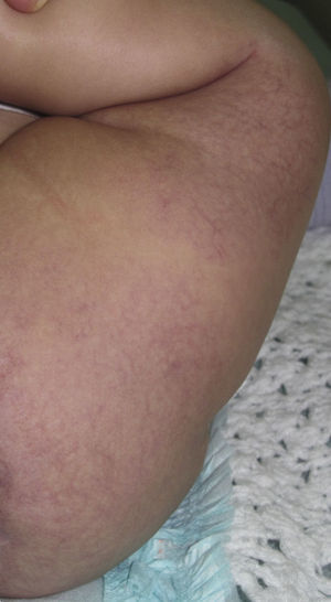 HCMD. Mácula eritematosa pálida sobre la que asientan múltiples telangiectasias finas.