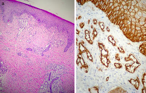 a) H-E 10 x. A nivel de la dermis superficial se observa proliferación de vasos con endotelios prominentes. b) Inmunomarcación: células endoteliales positivas para GLUT-1.
