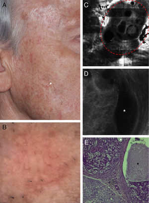 Correlation of clinical, dermoscopic, and reflectance confocal microscopy (RCM) images of a cystic basal cell carcinoma (BCC). (A) Clinical image of the lesion showing severe actinic damage with multiple actinic keratoses. On the right cheek a small skin-colored papule is observed (white arrow). (B) Dermatoscopic image of the lesion showing some telangiectasias around the papule. (C) RCM horizontal mosaic (4mm×4mm) obtained at the level of the superficial dermis showing multiple, round hyporefractile and non-refractile areas in a lobular arrangement (red circle). (D) Single RCM image (0.5mm×0.5mm) showing tumor islands with bright homogeneous centers surrounded by large dark clefts (white asterisk). (E) Histopathologic correlate showing a cystic variant of a BCC with basaloid tumor cells arranged in nests. Areas of mucin deposition (white asterisk) can be observed surrounding the tumor islands and forming cystic spaces (black asterisk).