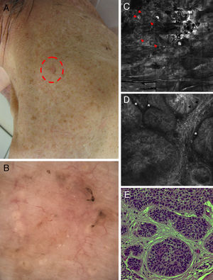 Correlation of clinical, dermoscopic, and reflectance confocal microscopy (RCM) images of a pigmented basal cell carcinoma (BCC) in an immunosuppressed patient after kidney transplantation. (A) Clinical image showing a flat erythematous plaque on the neck with brown pigmentation around the periphery of the lesion. (B) Dermoscopy reveals fine telangiectasias in the center and brown pigmentation at the border of the lesion. (C) RCM mosaic obtained at the level of the superficial dermis (4mm×4mm) shows multiple hyporefractile tumors islands in the upper dermis (red arrowheads). (D) On a single RCM image (0.5mm×0.5mm) these tumor islands display elongated nuclei with peripheral palisading (black arrowheads) and are separated from the surrounding stroma by dark, cleft-like spaces (white asterisk). (E) Hematoxylin–eosin histology shows tumor nodules comprising basaloid tumor cells with peripheral palisading and surrounding fibrous stroma.
