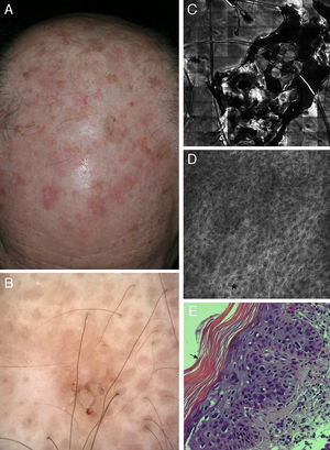 Correlation of clinical, dermoscopic, and reflectance confocal microscopy (RCM) images of an actinic keratosis (AK). (A) Clinical image reveals multiple erythematous to brown hyperkeratotic plaques on the scalp. (B) Dermoscopy reveals a brownish erythematous plaque with central scale lacking the classical strawberry pattern typical of AK. (C) RCM mosaic of the lesions obtained at the granular and spinous layer shows a central area of hyperkeratosis with amorphous material of medium to high reflectance. (D) RCM single image obtained at the periphery of the lesion demonstrates a broadened (black asterisk) and generally atypical honeycomb pattern with variations in cell and nuclei sizes and shapes. (E) Corresponding hematoxylin–eosin histology illustrates overlying hyperparakeratosis (black arrow) and epidermal proliferation of atypical keratinocytes.